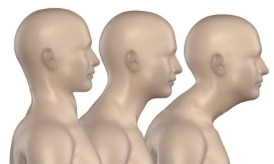 Garb żebrowy — co to jest? Jak usunąć garb żebrowy?